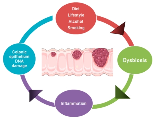 Zdroj obrázku: Vacante, M. et al. Gut Microbiota and Colorectal Cancer Development: A Closer Look to the Adenoma-Carcinoma Sequence. Biomedicines, 2020.